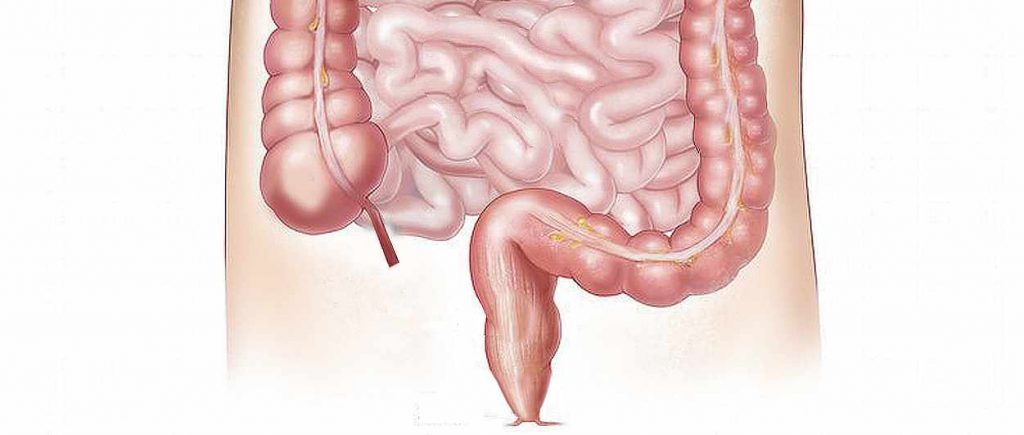 inflamacion colon intestino