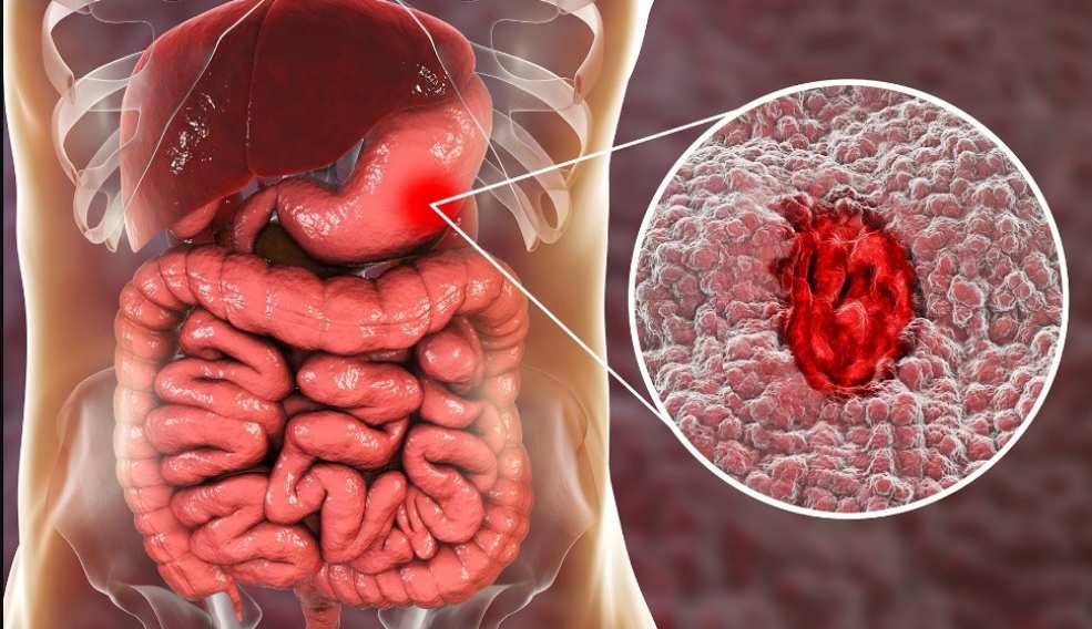 Úlcera estomacal: la ranitidina es un medicamento que alivia los síntomas de las úlceras estomacales
