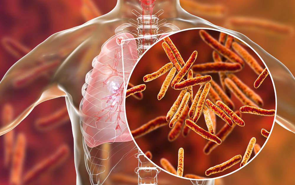 Tuberculosis: síntomas, factores, transmisión y tratamiento