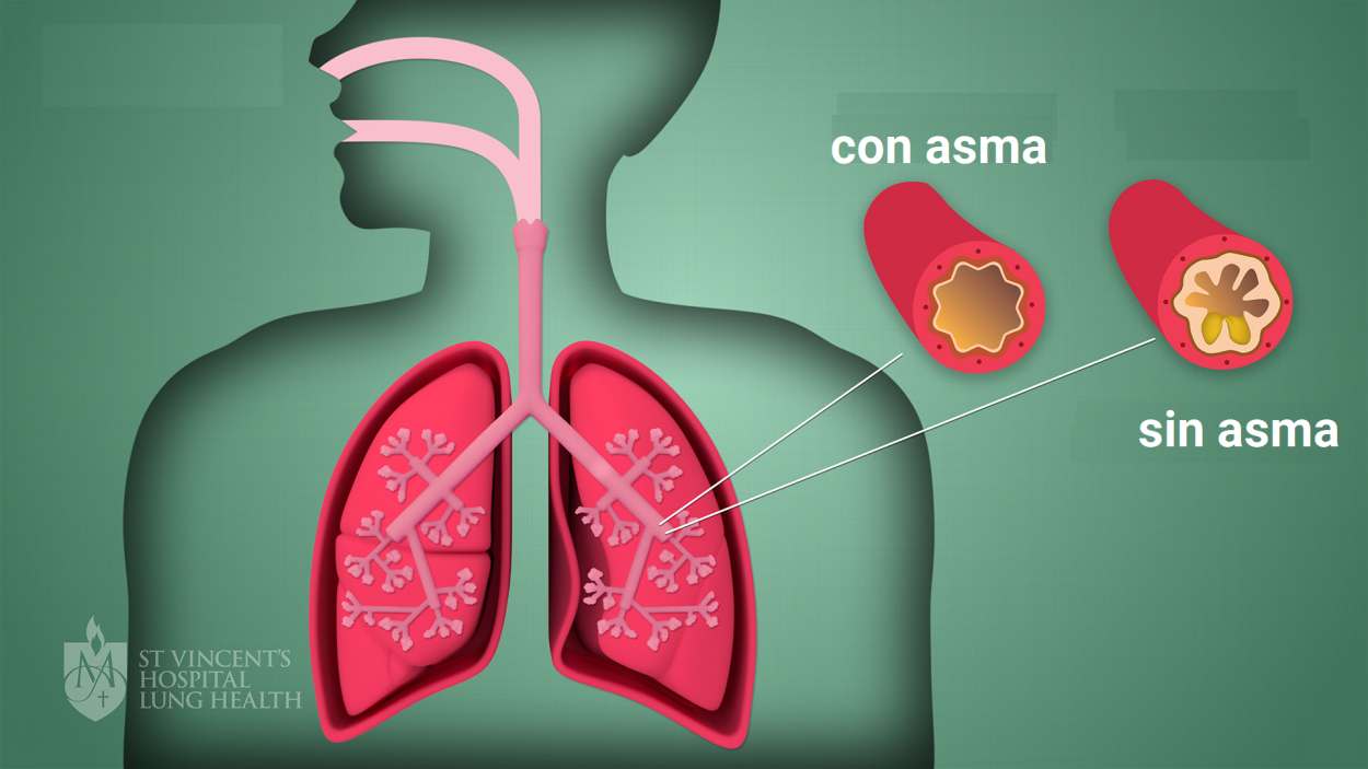 Asma: epidemiología, factores, síntomas, diagnóstico y tratamiento