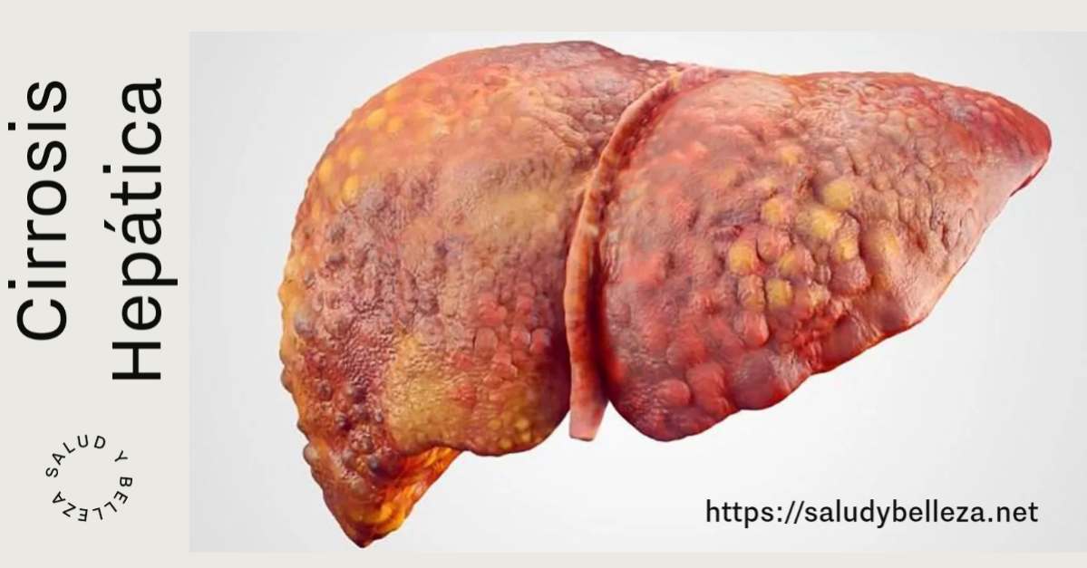Cirrosis hepática: epidemiología, causas, cuadro clínico, diagnóstico y tratamiento