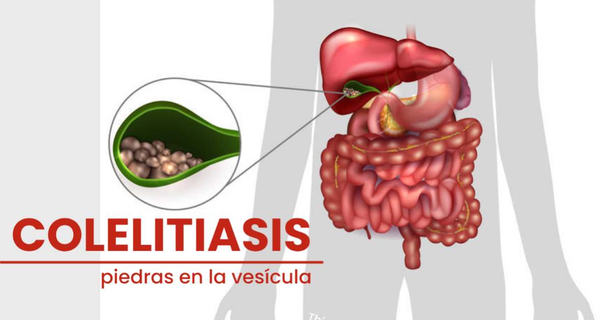 Colelitiasis (piedras en la vesícula biliar): factores, síntomas, diagnóstico y tratamiento