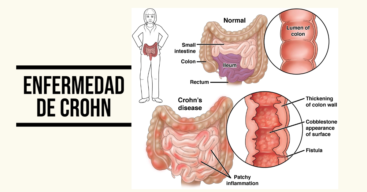 Enfermedad de Crohn ¿qué es? factores, síntomas, tratamiento