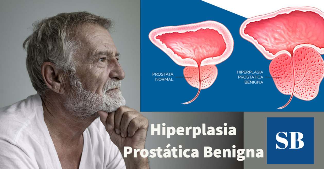 Hiperplasia prostática benigna (HBP): ¿qué es? síntomas y tratamiento