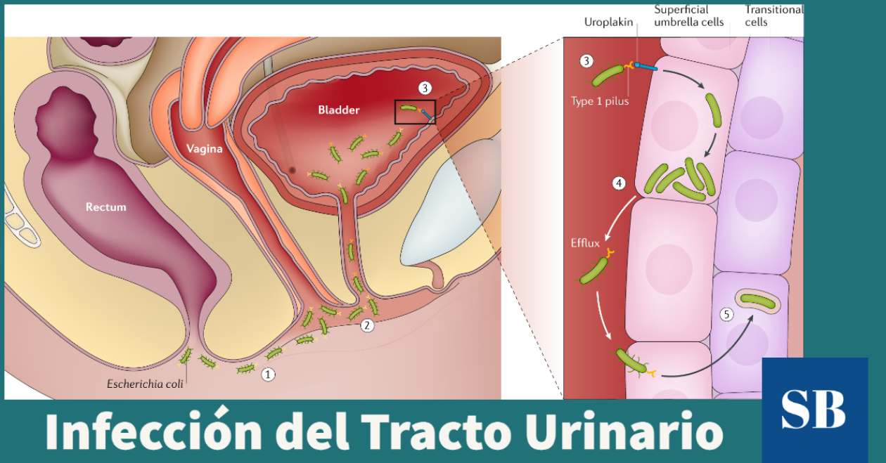 Infección del Tracto Urinario (ITU): causas, prevención, tratamiento