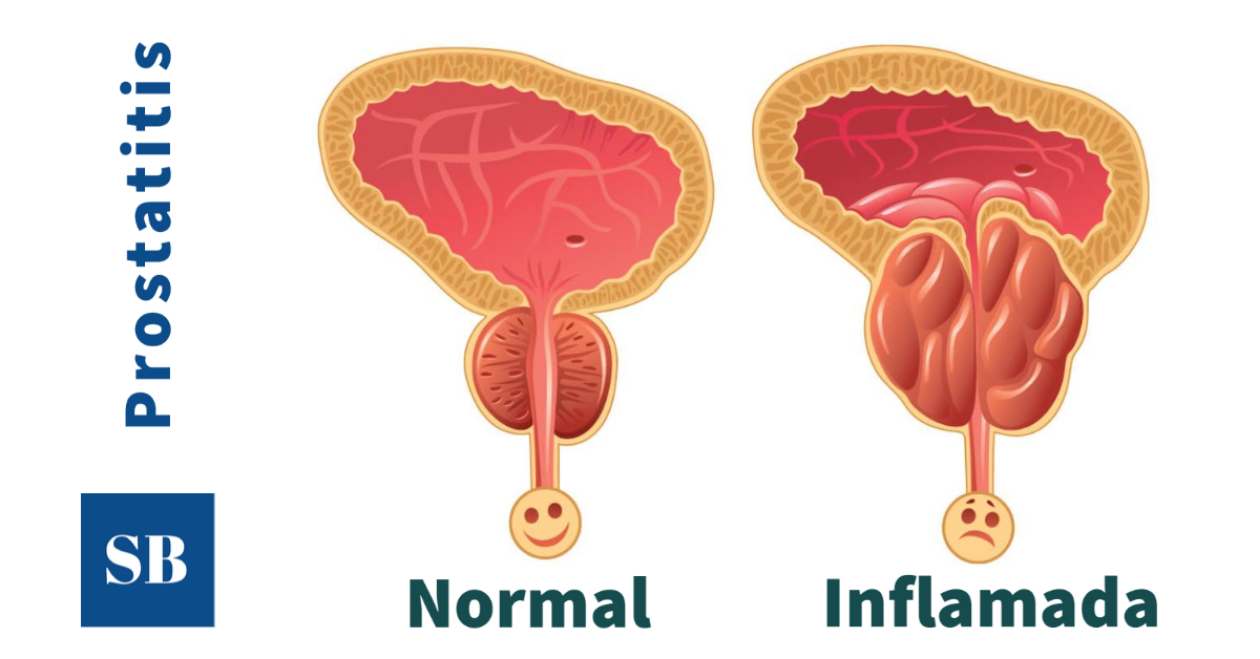 Prostatitis (inflamación de la próstata): factores, clasificación, diagnóstico y tratamiento