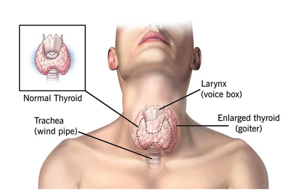 Tiroiditis de Hashimoto: ¿qué es? síntomas, causas, cuadro clínico, tratamiento