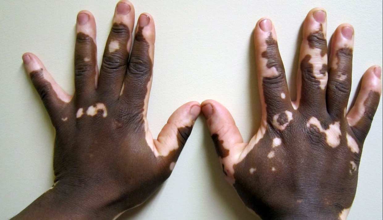 Vitiligo: ¿qué es esta enfermedad de la piel? Causas, factores, tratamiento