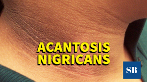 ¿Qué es la Acantosis Nigricans? causas, síntomas, relación con la insulina/diabetes