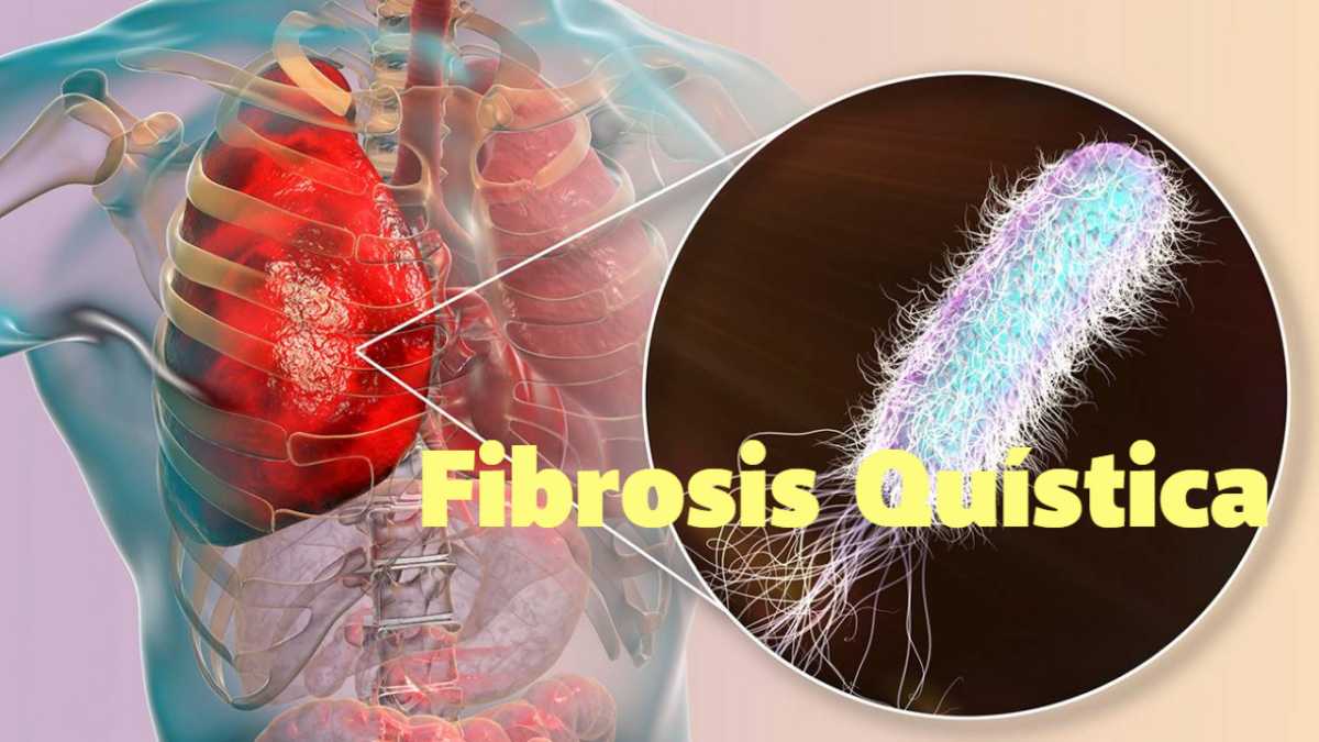 Fibrosis Quística: ¿Qué es? Causas y síntomas (CFTR)
