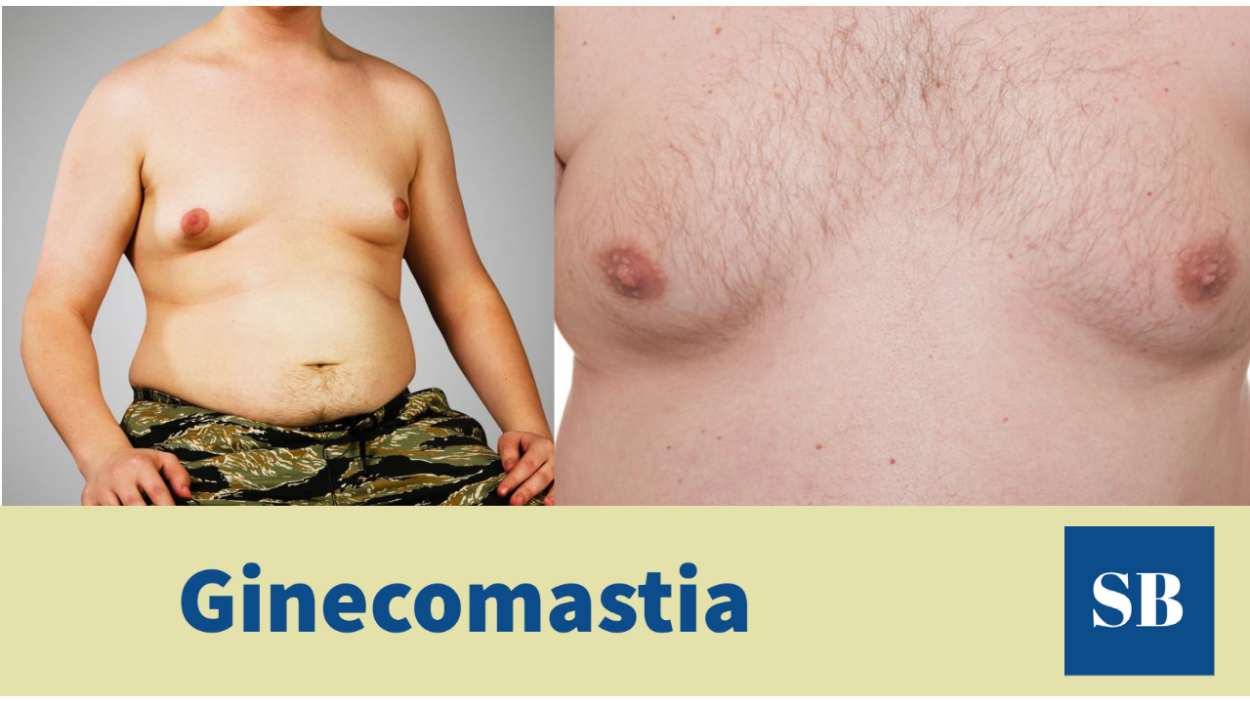 Ginecomastia (hombres): causas, cuadro clínico y tratamiento