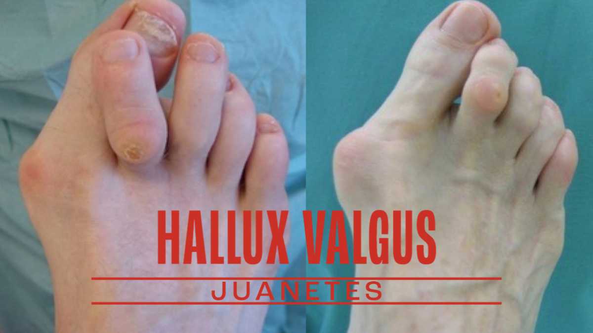 Todo lo que necesitas saber sobre Hallux Valgus o juanetes: causas, síntomas y tratamientos